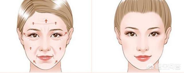 微创面部除皱术，微创面部除皱术的五大优点