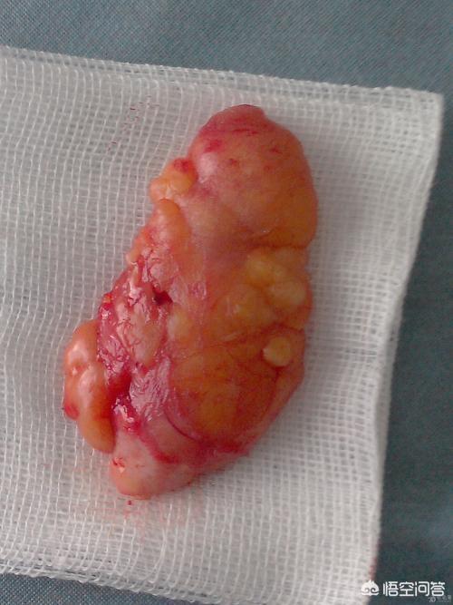 头条问答 - 脂肪瘤会自己消失吗?(6个回答)