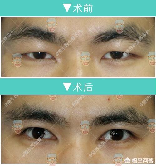 眼部吸脂手术(眼部吸脂手术的价格)