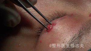 眼部吸脂手术(眼部吸脂手术的价格)