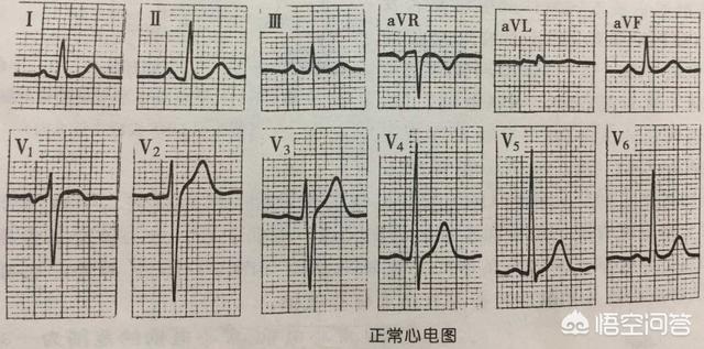 正常心电图图片,看心电图正常不正常应该怎样看？