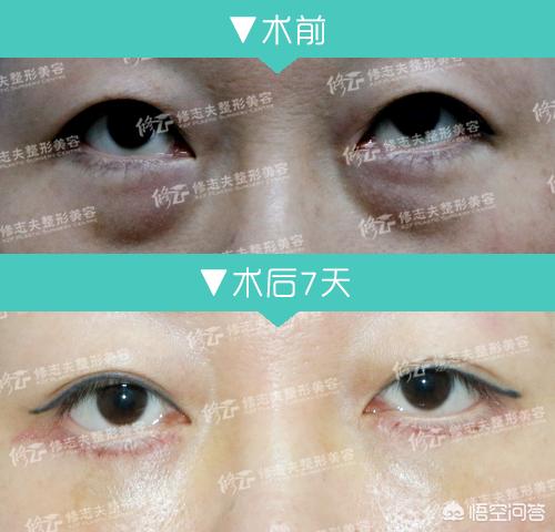 眼部吸脂手术(眼部吸脂手术的价格)