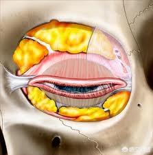 眼部吸脂手术(眼部吸脂手术的价格)