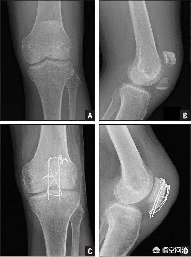 膑骨粉碎性骨折怎么练:髌骨粉碎性骨折手术后，多长时间能灰复正常弯曲？