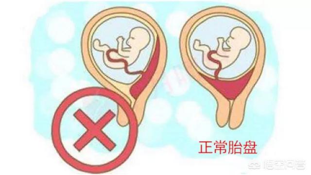 孕12周胎盘见光点怎么回事:12周做NT正常，但是报告胎位前置，该怎么办啊？