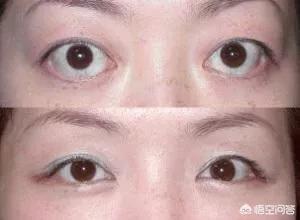 甲亢突眼症能治愈么:甲亢突眼能治疗好吗，应该注意什么？