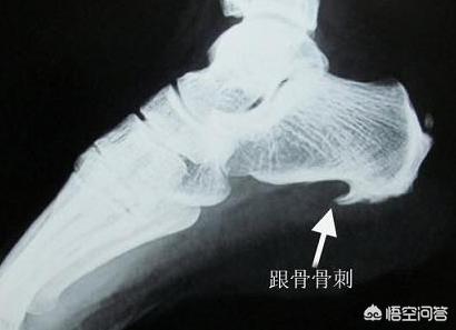 脚后跟疼是什么原因,足后跟痛什么原因引起的？