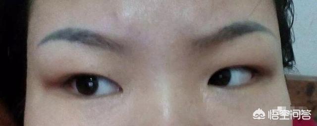 古巨基割双眼皮:想割双眼皮，但是害怕失败留疤，做过手术的人有哪些经验分享