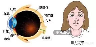 甲亢突眼症能治愈么:甲亢突眼能治疗好吗，应该注意什么？