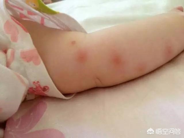 怎么预防孩子体内的寄生虫，天气热了，如何预防宝宝被虫子叮咬