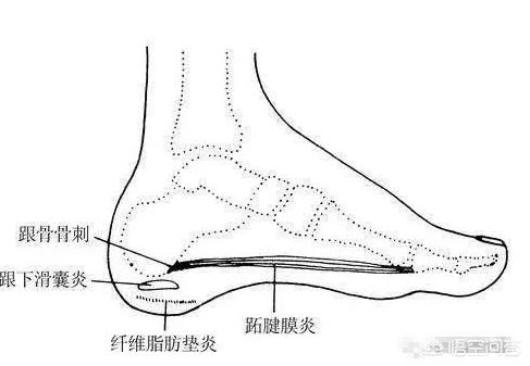 脚后跟疼是什么原因,足后跟痛什么原因引起的？