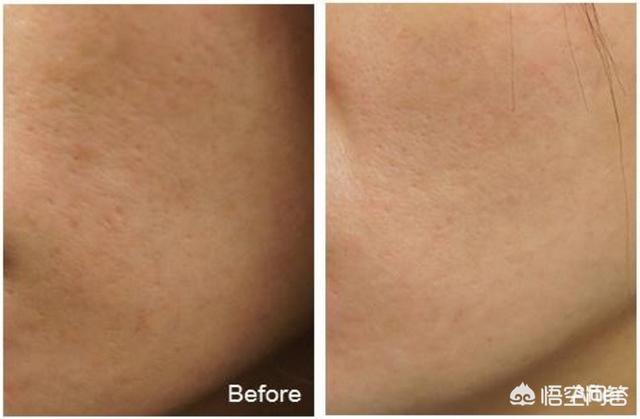 豆坑怎么办(脸上全是痘坑怎么办)