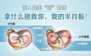 悟空问答 膝盖半月板撕裂 还能恢复吗 多久才能恢复 21个回答