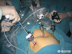腹腔镜手术后注意事项:腹腔镜手术后注意事项及护理 宫腹腔镜微创手术后怎么调理能早点怀孕？