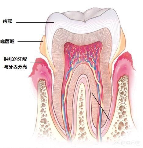 老婆有牙周炎会传染吗:牙周炎不及时治疗会有什么危害？