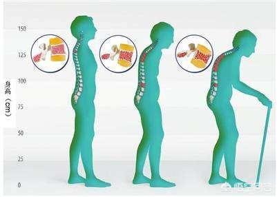 得了骨质疏松为什么会变矮