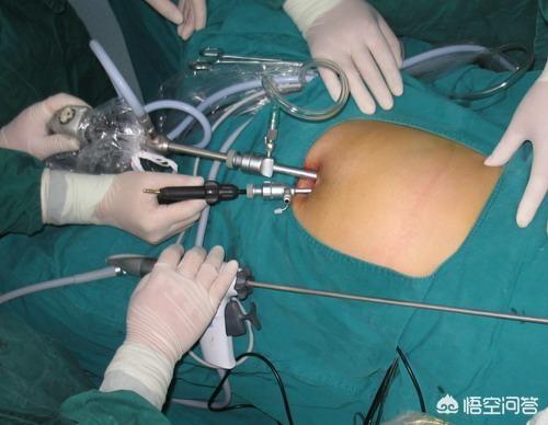 悟空问答 手术后用什么方法排气快 59个回答
