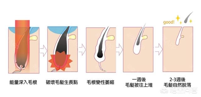 日本jg脱毛症用剂有用吗:用脱毛膏会对皮肤造成伤害吗？