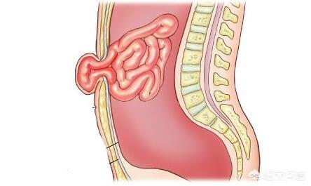 宝宝脐疝:宝宝脐疝是不是父母护理不当造成的？