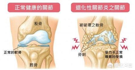 膝盖软骨磨损微创手术费用:关节软骨磨损真的不可逆吗？