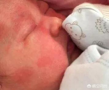 新生儿毒性红斑，刚出生三天的宝宝脸上身上有红点，是怎么回事