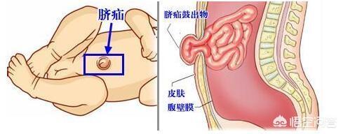 曲善宝脐疝带:小宝宝疝气是怎么得的，哭真的会得疝气吗？