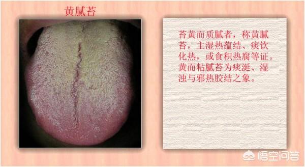 大便不成形粘马桶:舌苔厚腻、大便不成形是湿气重吗？怎么祛除湿气？