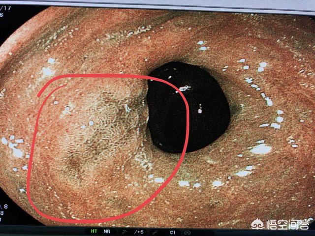 病理学与病理生理学病例分析及答案:为什么胃镜检查出慢性浅表性胃炎和糜烂了还要做病理？