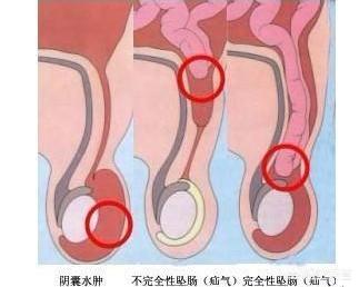 曲善宝脐疝带:小宝宝疝气是怎么得的，哭真的会得疝气吗？