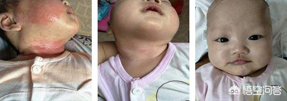 宝宝脸上最近长湿疹了，是怎么回事？
