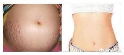 怀孕多久会长妊娠纹？为什么会长妊娠纹？插图34