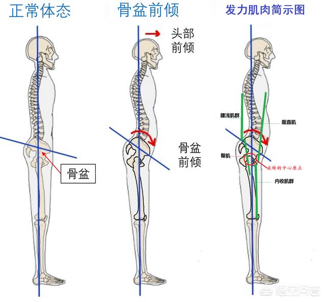 腰突并有骨盆前倾症状的人该怎样锻炼呢？