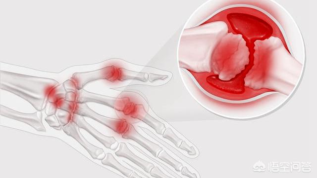 怎么增强自身免疫力抵抗类风湿性关节炎:风湿类风湿性关节炎有哪些注意事项？
