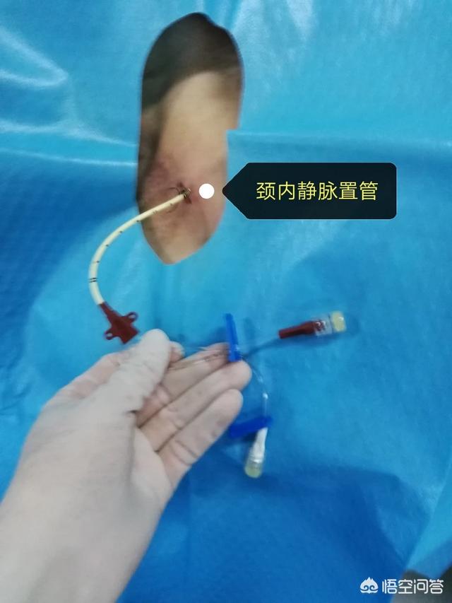 清创手术需要麻醉吗:脚部清创手术需要麻醉吗? 麻醉很痛吗？只是睡一觉吗？