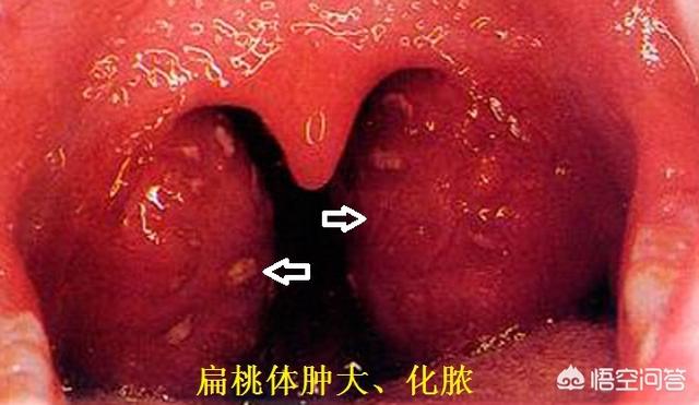 头条问答 化脓性扁桃体炎是什么感染 逸仙药师的回答 0赞