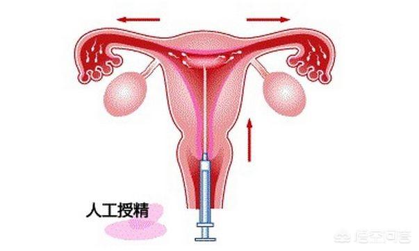 宫腔内人工授精，人工授精一次可以成功吗？