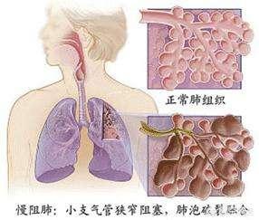 慢阻肺患者如何居家康复-慢阻肺患者的康复内容