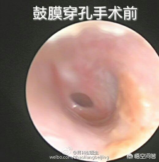 耳朵鼓膜破裂了还能长好吗?