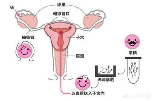 宫腔内人工授精，人工授精一次可以成功吗？