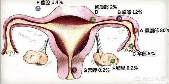 诊断宫外孕比较简单的方法是什么，诊断宫外孕比较简单的方法是什么