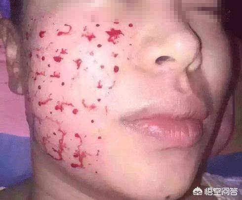 倪妮凸点真空照:水光针的效果怎么样最近想打水光针，有副作用吗