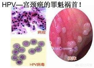 宫颈癌高发年龄,HPV感染的情况常见吗？