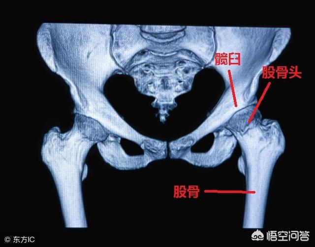 髋关节脱位:先天性髋关节脱位手术前后的护理及出院指导？