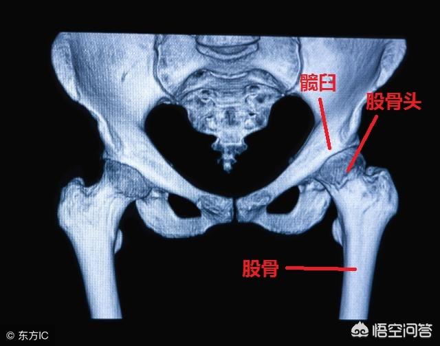 先天性髋关节脱位:儿童先天性髋关节脱位可以不用做手术治好吗？