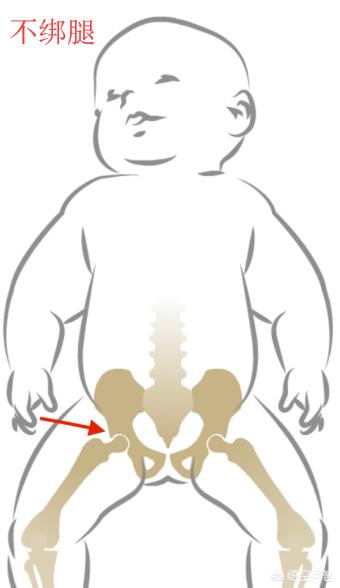 髋关节脱位:先天性髋关节脱位的原因是什么？