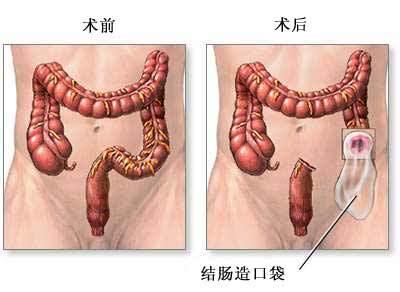 赵斗淳为什么掏素媛肠子:什么是肠造口，直肠癌手术后必须有造口吗？