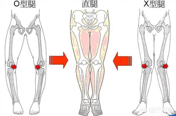 怎么矫正XO型腿，O型腿有成功矫正的例子嘛