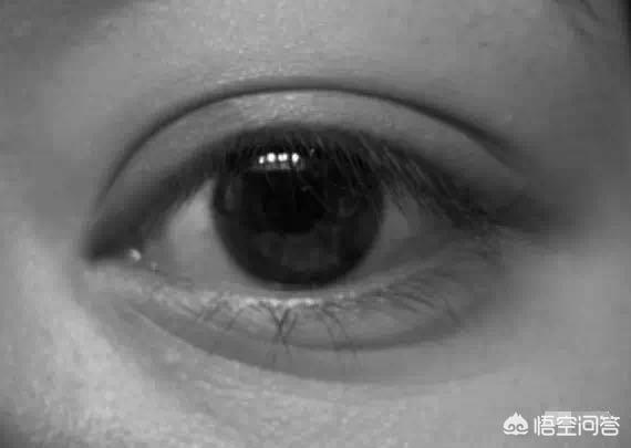 开眼角对比图:割双眼皮不开眼角是一种什么体验？