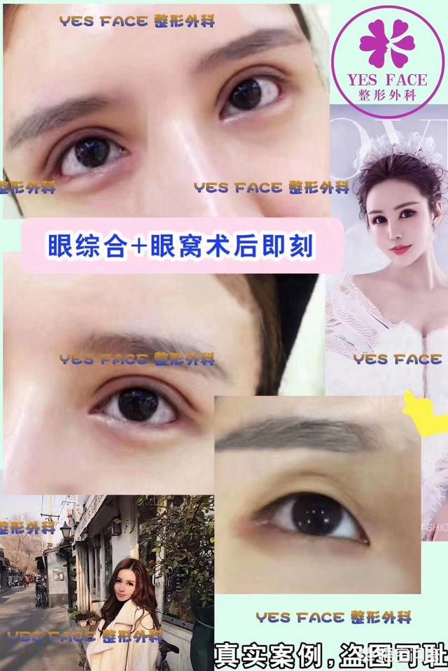 开眼角对比图:割双眼皮不开眼角是一种什么体验？