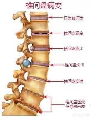 腰沐刻机椎间盘突出怎么治疗:腰椎舒缓器可以治疗椎间盘膨出吗 目前腰间盘突出手术成功率有多少？小手术效果如何？